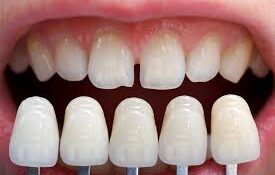 Porcelain Veneers