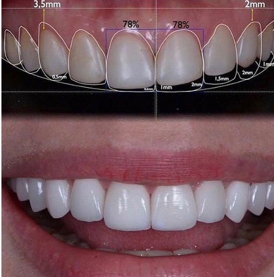 Zirconium Crowns Prices