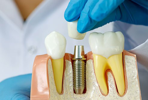 dental-implants