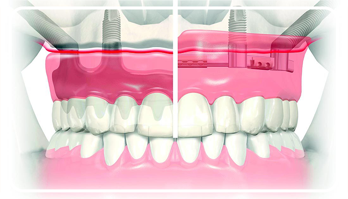 What is a Zygomatic Implant